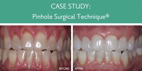 gum grafting vs pinhole surgery.